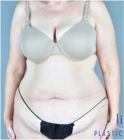 Tummy Tuck Before & After Patient #325