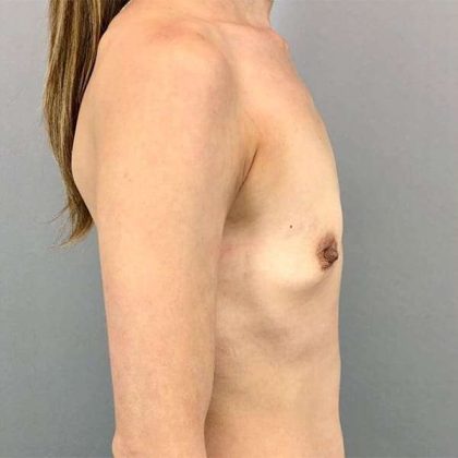 Breast Augmentation Before & After Patient #1329