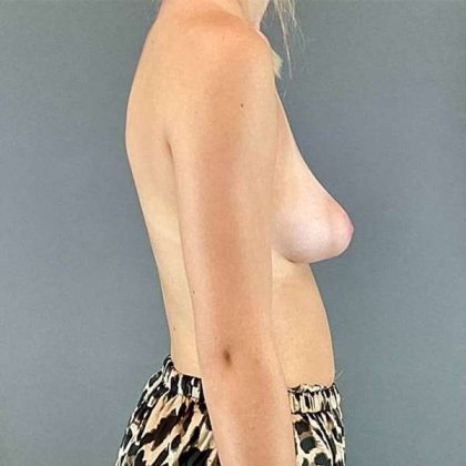 Breast Augmentation Before & After Patient #1340