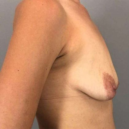 Breast Augmentation Before & After Patient #1351