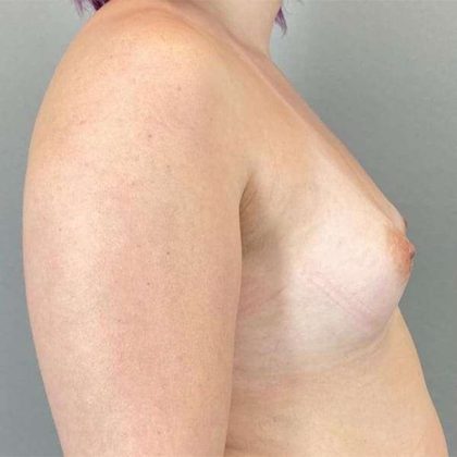 Breast Augmentation Before & After Patient #1362