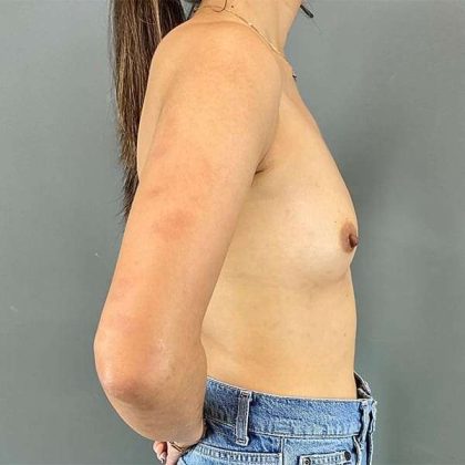 Breast Augmentation Before & After Patient #1373