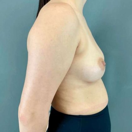 Breast Augmentation Before & After Patient #1406