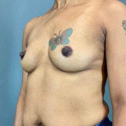 Breast Augmentation Before & After Patient #1428