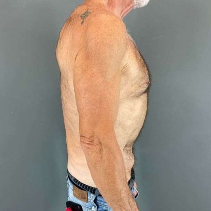 Gynecomastia Before & After Patient #642