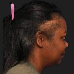 Hair Restoration Before & After Patient #3838