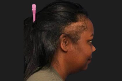 Hair Restoration Before & After Patient #3838