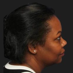 Hair Restoration Before & After Patient #3838