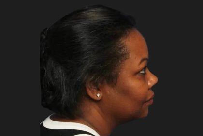 Hair Restoration Before & After Patient #3838