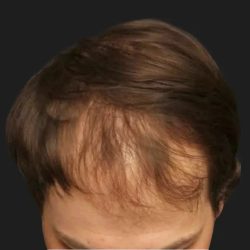 Hair Restoration Before & After Patient #3843