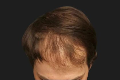 Hair Restoration Before & After Patient #3843