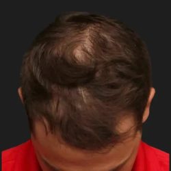Hair Restoration Before & After Patient #3843
