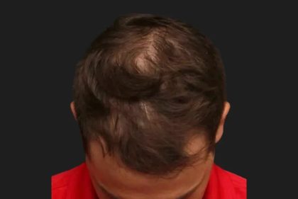 Hair Restoration Before & After Patient #3843